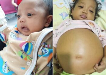 Naura, Anak Warga Teminabuan Butuh Bantuan