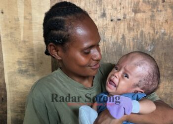 Bayi Penderita Hidrosefalus & Jantung Bocor di Sorong Butuh Biaya Pengobatan