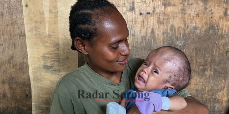 Bayi Penderita Hidrosefalus & Jantung Bocor di Sorong Butuh Biaya Pengobatan